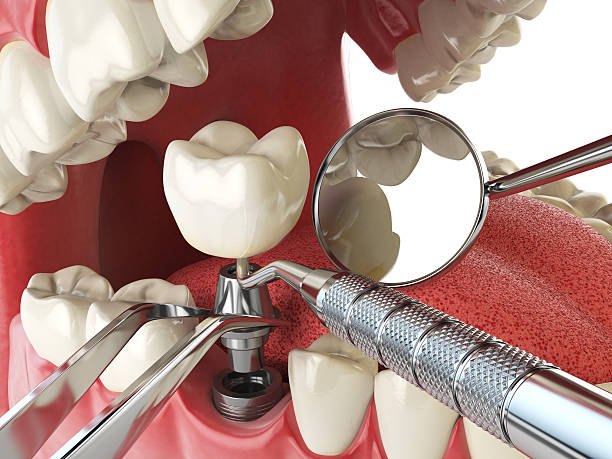 Best Urgent Care for Lost Fillings or Crowns in Waterville, MN